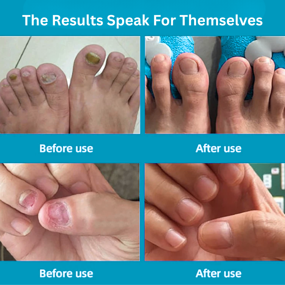 NailPro Fungus Remover